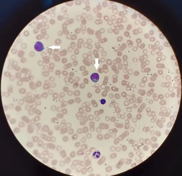 形态,发现很多异常淋巴细胞,该细胞群:胞体较大,胞质深染,染色质较粗