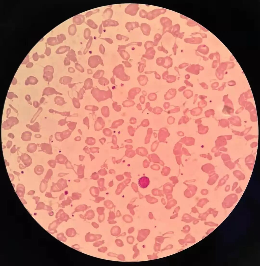 当看到视野里大小不等,形态各异的红细胞以及星点分布的血小板,答案