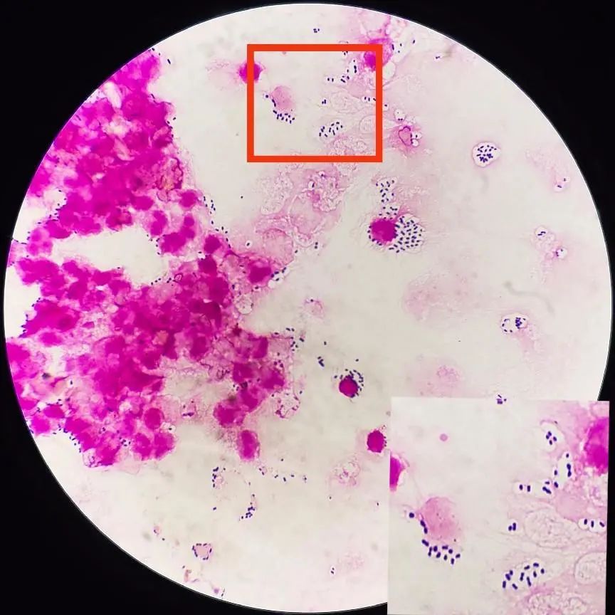 1000圖6 腦脊液培養報告案例分析化膿性腦膜炎腦脊液特點主要有:①