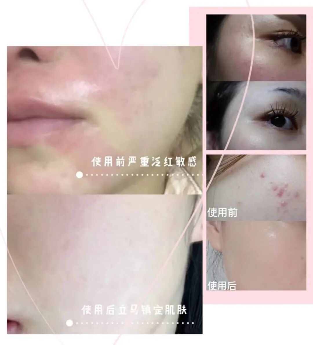 医用液体敷料怎么使用美人团福利团品①：荣晟医用级液体敷料_https://www.jmylbn.com_新闻资讯_第7张