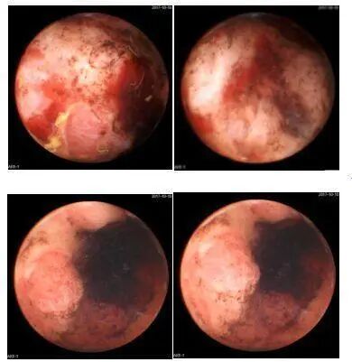 什么是260胃镜胶囊胃镜检查中发现： 胃癌发病率远超想象，50岁以上是重灾区_https://www.jmylbn.com_新闻资讯_第4张