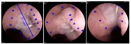 什么是260胃镜胶囊胃镜检查中发现： 胃癌发病率远超想象，50岁以上是重灾区_https://www.jmylbn.com_新闻资讯_第2张