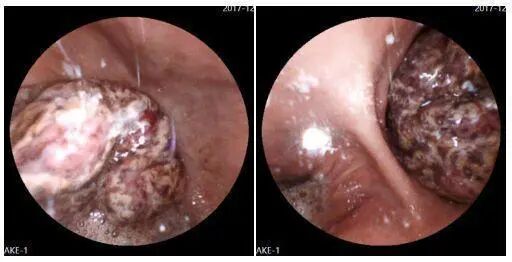什么是260胃镜胶囊胃镜检查中发现： 胃癌发病率远超想象，50岁以上是重灾区_https://www.jmylbn.com_新闻资讯_第5张
