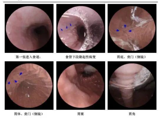 什么是260胃镜胶囊胃镜检查中发现： 胃癌发病率远超想象，50岁以上是重灾区_https://www.jmylbn.com_新闻资讯_第3张