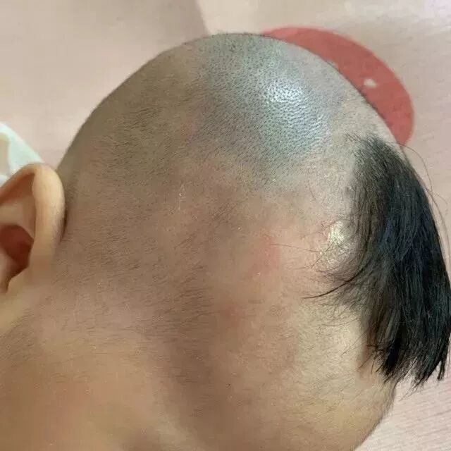 婆婆偷偷给宝宝剃光头 第二天头皮变成了这样 心疼 年糕妈妈 微信公众号文章阅读 Wemp