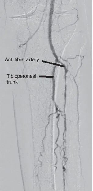 什么是外周支架雁过留声, 但它什么也没留下-外周可回收支架系统_https://www.jmylbn.com_新闻资讯_第21张