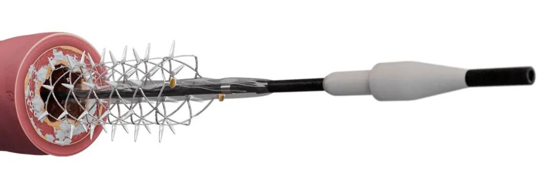 什么是外周支架雁过留声, 但它什么也没留下-外周可回收支架系统_https://www.jmylbn.com_新闻资讯_第7张