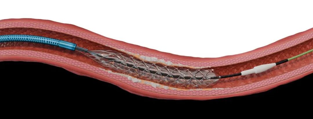 什么是外周支架雁过留声, 但它什么也没留下-外周可回收支架系统_https://www.jmylbn.com_新闻资讯_第8张