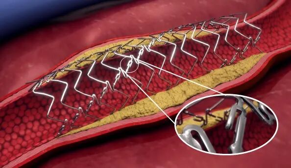 什么是外周支架雁过留声, 但它什么也没留下-外周可回收支架系统_https://www.jmylbn.com_新闻资讯_第30张