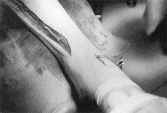 pta在医学上什么意思足背动脉旁路术：从技术革新到精准医疗_https://www.jmylbn.com_新闻资讯_第23张