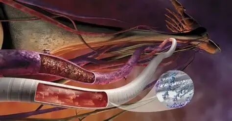 pta在医学上什么意思足背动脉旁路术：从技术革新到精准医疗_https://www.jmylbn.com_新闻资讯_第27张