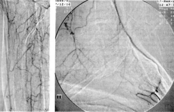pta在医学上什么意思足背动脉旁路术：从技术革新到精准医疗_https://www.jmylbn.com_新闻资讯_第22张