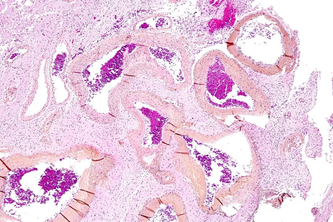 图说动静脉畸形
