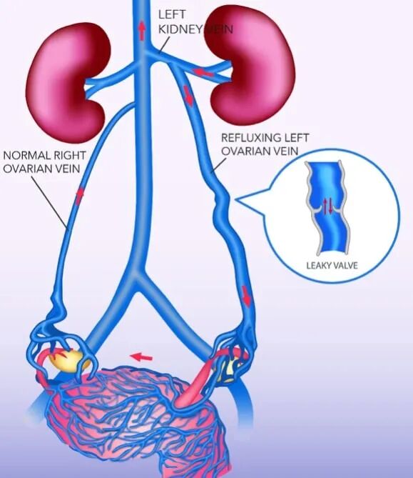 子宫支架是什么髂静脉支架能否耐受妊娠子宫？_https://www.jmylbn.com_新闻资讯_第10张