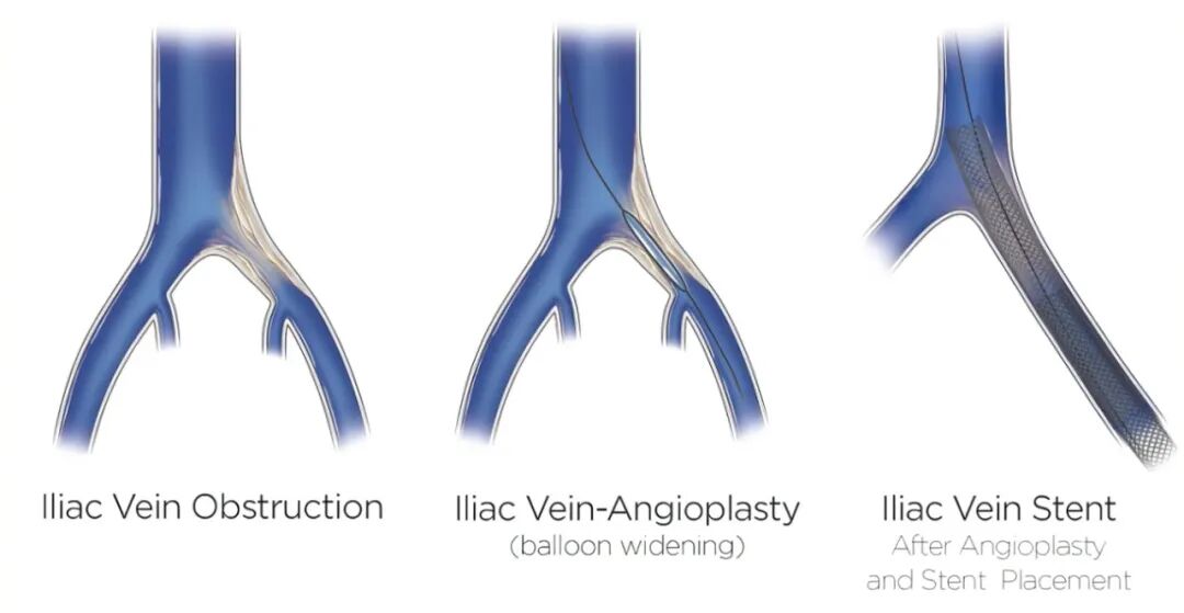子宫支架是什么髂静脉支架能否耐受妊娠子宫？_https://www.jmylbn.com_新闻资讯_第11张