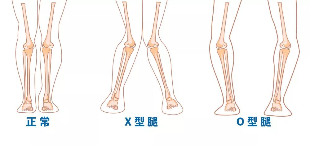 腿型测试 别让x型腿 O型腿毁了你 健力多天猫旗舰店