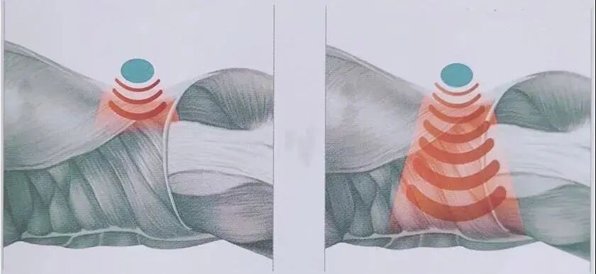 疼痛仪怎么回事快来看！激光磁场理疗仪疼痛的克星！_https://www.jmylbn.com_新闻资讯_第4张