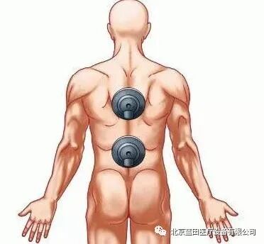 体外短波电容为什么要做短波治疗应用干货！康复科必读！_https://www.jmylbn.com_新闻资讯_第10张