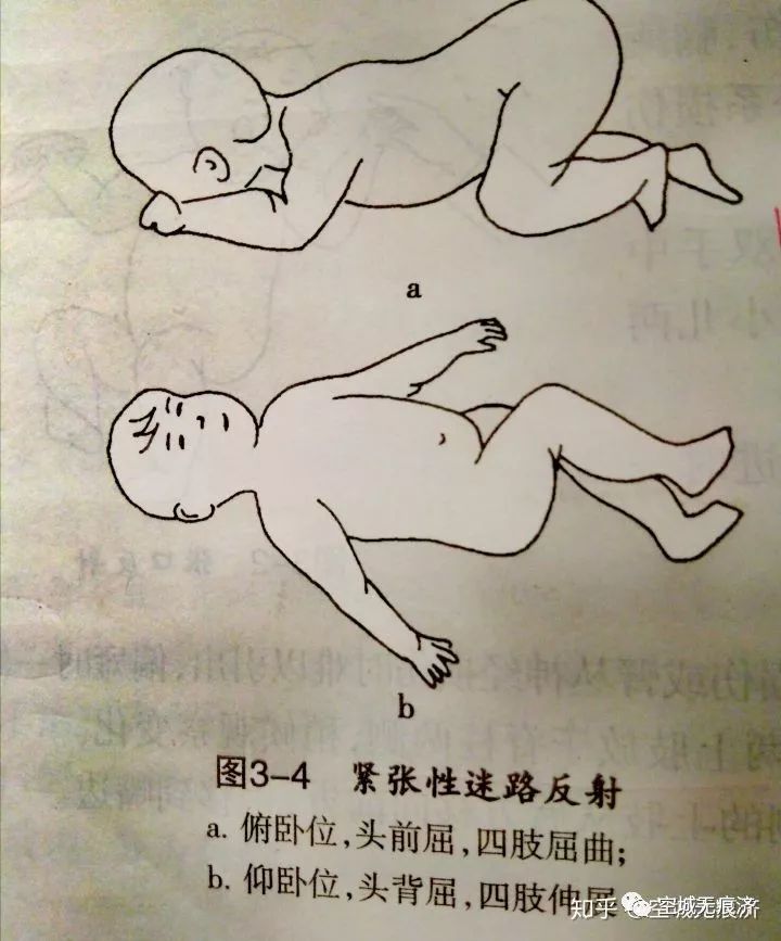 身体以屈曲姿势为主，头部前屈 ，臀部凸起。（3） 存在时期：0～4个月。9.非对称性紧张性颈反射(a