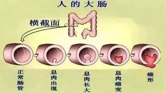 大肠息肉，是癌的近亲，很可能恶变！