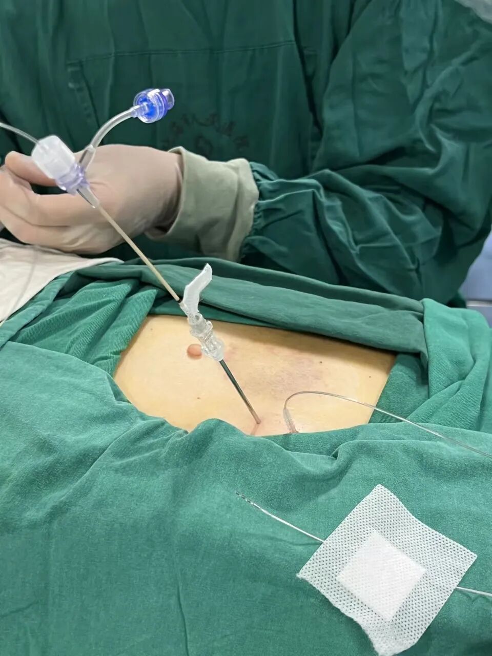 医疗电击器叫什么疼痛科用“电击疗法”治疗65岁阿姨“会呼吸的痛”_https://www.jmylbn.com_新闻资讯_第3张