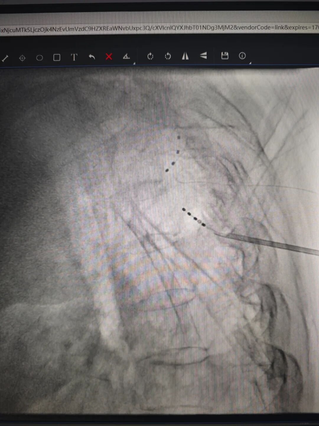 医疗电击器叫什么疼痛科用“电击疗法”治疗65岁阿姨“会呼吸的痛”_https://www.jmylbn.com_新闻资讯_第4张