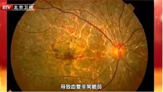 气血通络仪效果怎么样视力下降、眼前黑影…一个方法自测眼健康！医生调脏通络补气血，防治眼病不复发_https://www.jmylbn.com_新闻资讯_第2张