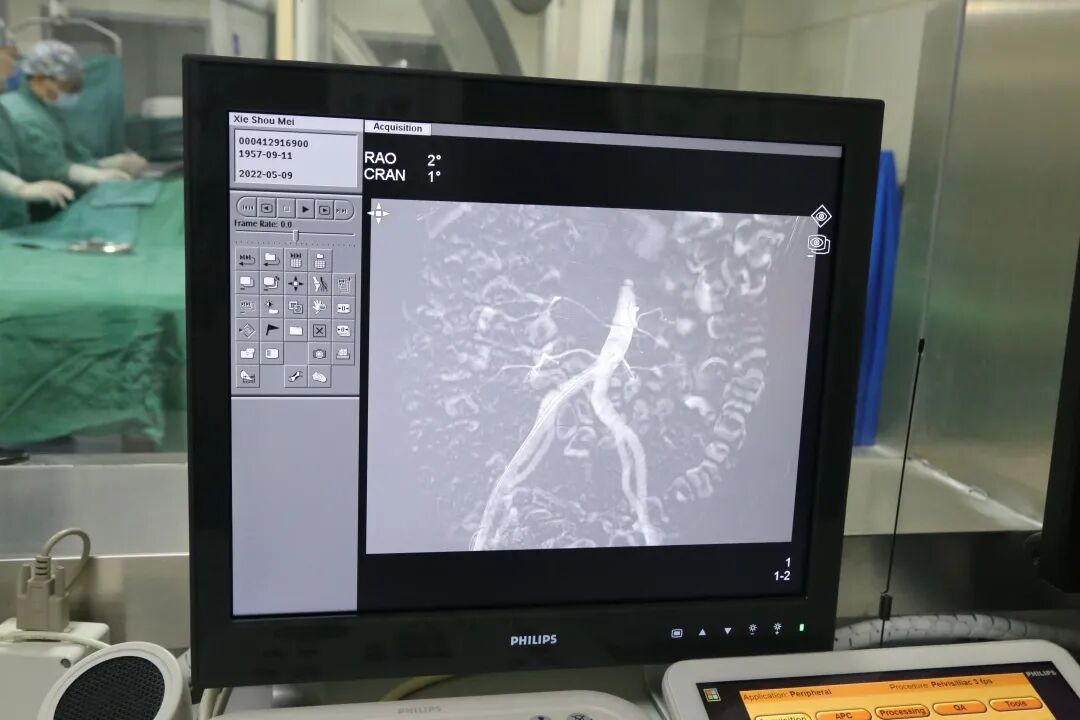 dsa是什么设备DSA设备再升级 介入技术又添新招 为患者带来康复新希望_https://www.jmylbn.com_新闻资讯_第13张