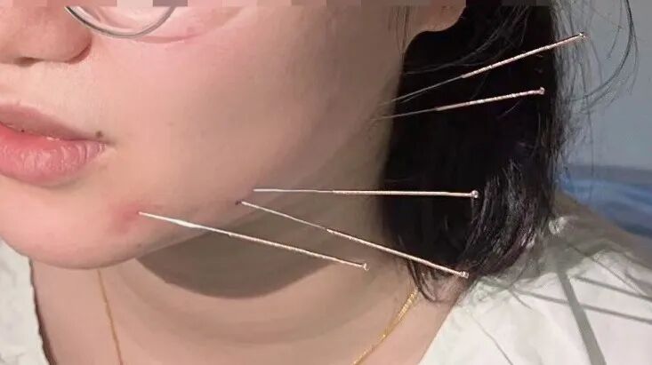 妇科脉冲怎么回事女性盆腔痛莫要慌 ，中医外治有良方！我院妇科医师推荐中医外治特色项目服务_https://www.jmylbn.com_新闻资讯_第8张