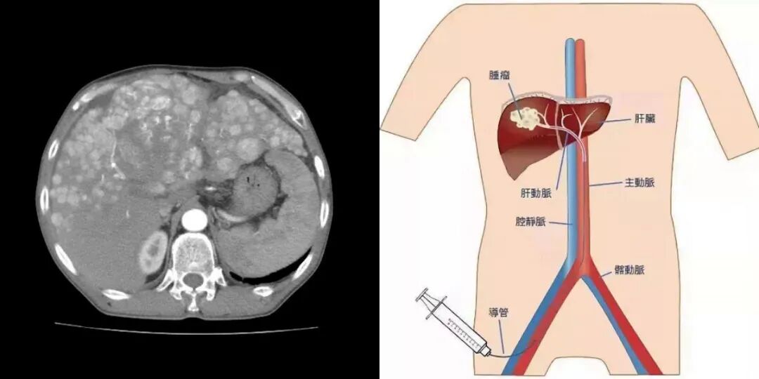 tai是什么治疗肝癌治疗“利器”——肝动脉灌注化疗术（HAIC）-上海聚慕医疗器械有限公司