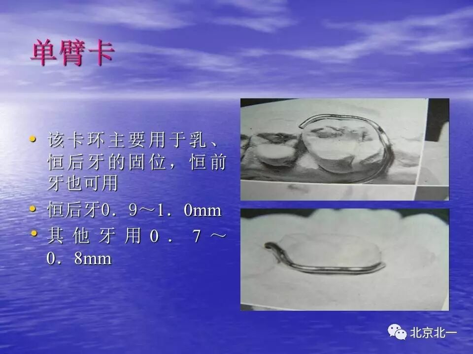 【正畸】活动矫治器