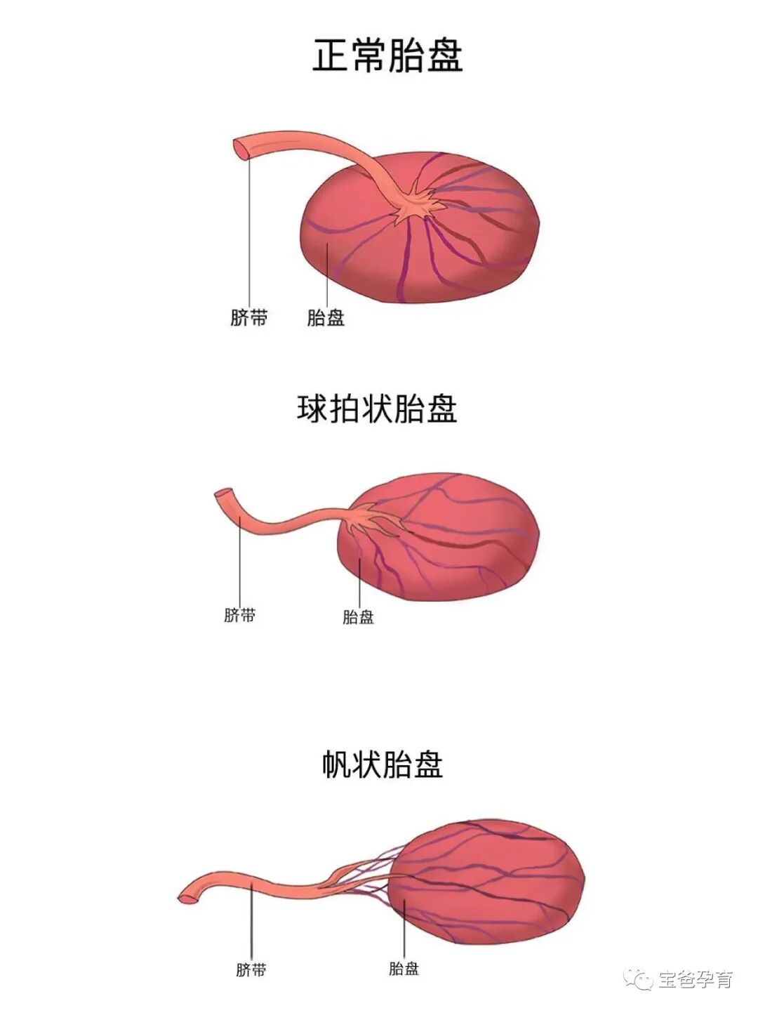 一次性脐带包怎么用怀孕不焦虑｜产检B超脐带异常一次性说清楚!_https://www.jmylbn.com_新闻资讯_第3张