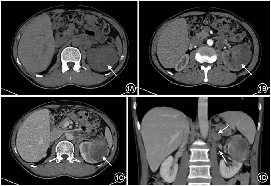 fh染色是什么意思延胡索酸水合酶缺陷型肾细胞癌临床诊治共识_https://www.jmylbn.com_新闻资讯_第2张