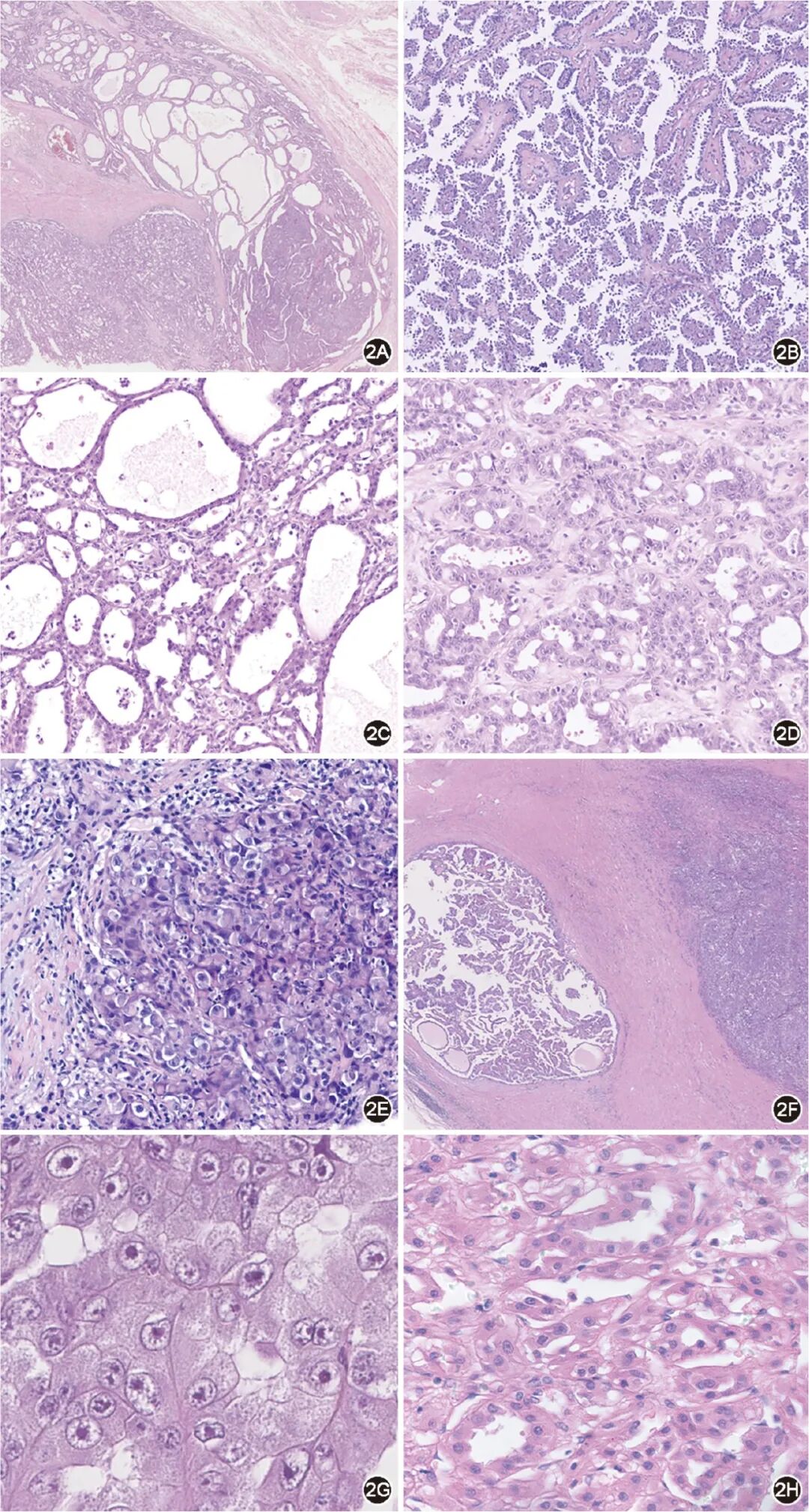 fh染色是什么意思延胡索酸水合酶缺陷型肾细胞癌临床诊治共识_https://www.jmylbn.com_新闻资讯_第3张