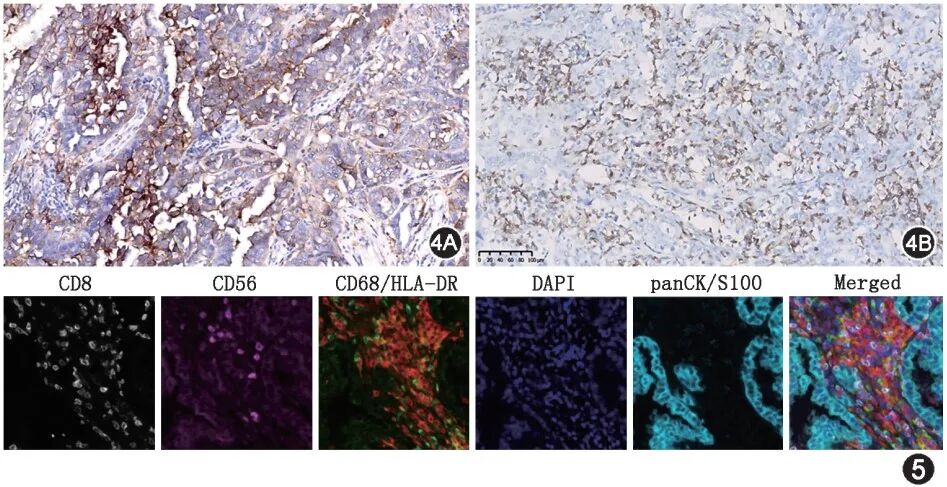 fh染色是什么意思延胡索酸水合酶缺陷型肾细胞癌临床诊治共识_https://www.jmylbn.com_新闻资讯_第5张