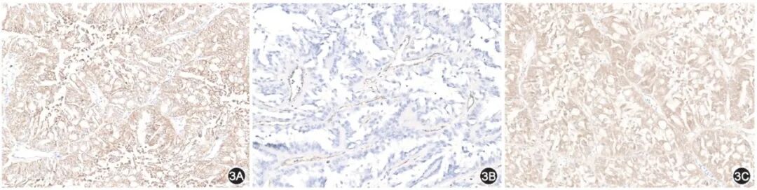 fh染色是什么意思延胡索酸水合酶缺陷型肾细胞癌临床诊治共识_https://www.jmylbn.com_新闻资讯_第4张
