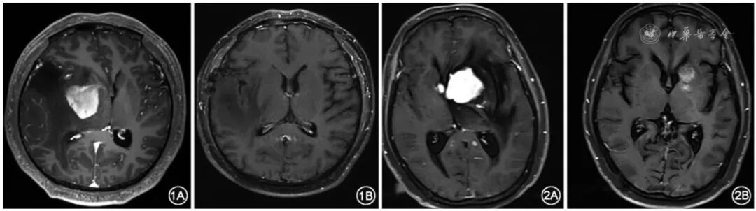 人喝活检怎么急救陈双成｜急诊危重症原发性中枢神经系统淋巴瘤患者天坛医院急救方案的疗效分析_https://www.jmylbn.com_新闻资讯_第4张