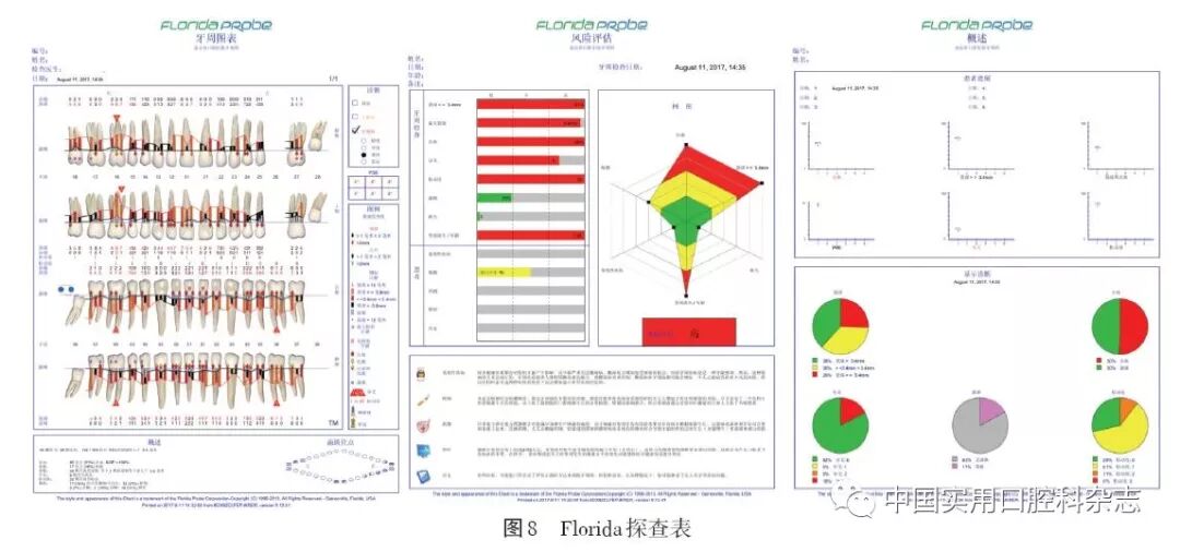 牙石探针怎么用专题笔谈 ｜ 牙周探针及探诊技术的进展及临床应用_https://www.jmylbn.com_新闻资讯_第9张
