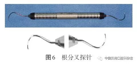 牙石探针怎么用专题笔谈 ｜ 牙周探针及探诊技术的进展及临床应用_https://www.jmylbn.com_新闻资讯_第6张