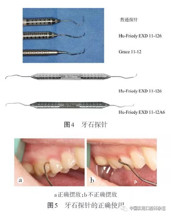 牙石探针怎么用专题笔谈 ｜ 牙周探针及探诊技术的进展及临床应用_https://www.jmylbn.com_新闻资讯_第5张