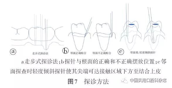 牙石探针怎么用专题笔谈 ｜ 牙周探针及探诊技术的进展及临床应用_https://www.jmylbn.com_新闻资讯_第7张