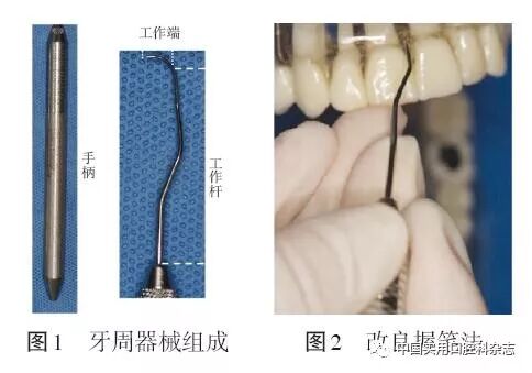 牙石探针怎么用专题笔谈 ｜ 牙周探针及探诊技术的进展及临床应用_https://www.jmylbn.com_新闻资讯_第3张