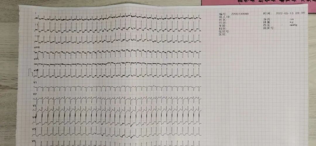 杭州顾连玺桥康复医院给脑出血昏迷昏迷的王太太做的检查诊断