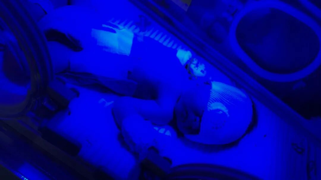 为什么要用光疗纸尿裤科普｜“黄疸宝宝”日间光疗病房来啦~_https://www.jmylbn.com_新闻资讯_第3张