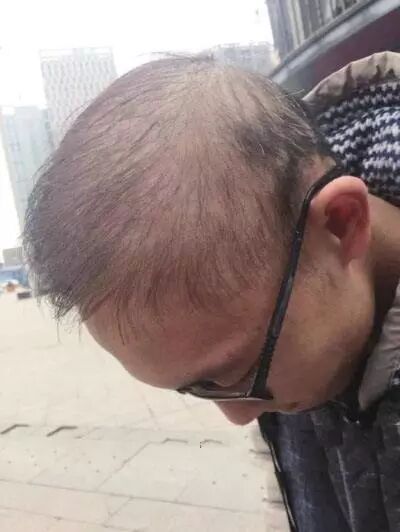 头发掉的厉害是什么原因头发掉的厉害怎么办