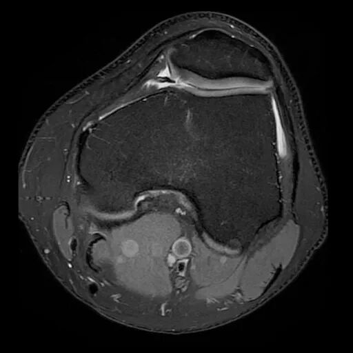 病例讲解髌骨内侧滑膜皱襞综合征