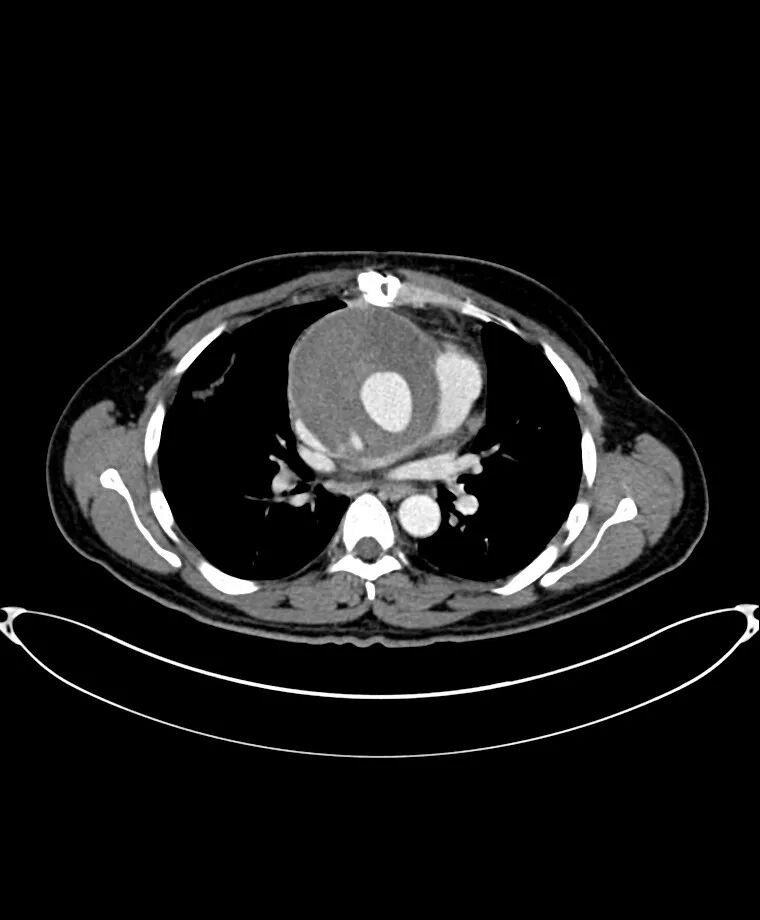 stanford a型主动脉夹层_医学界-助力医生临床决策和职业成长