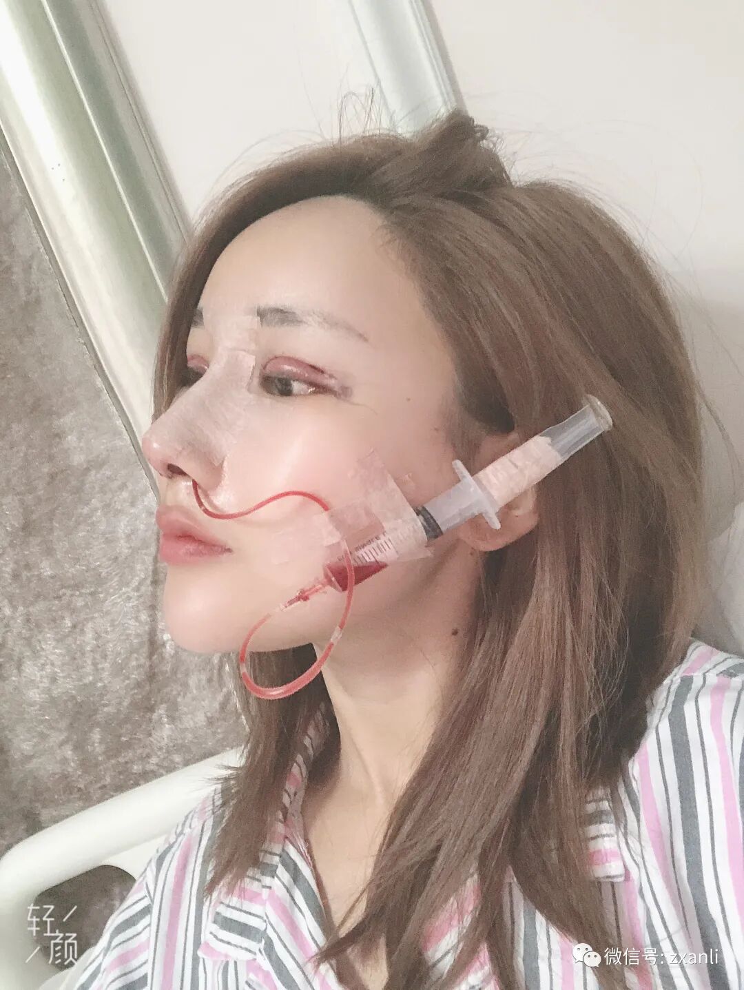 综合鼻子引流管在哪里鼻综合47天，跟大家分享我美美的鼻子_https://www.jmylbn.com_新闻资讯_第4张