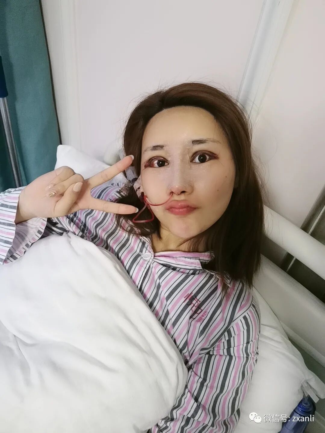 综合鼻子引流管在哪里鼻综合47天，跟大家分享我美美的鼻子_https://www.jmylbn.com_新闻资讯_第2张