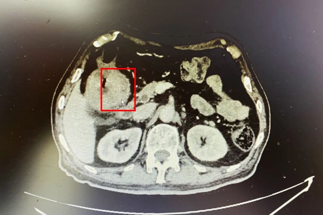89岁老兵意外查出肠癌，超高龄手术“禁区”，怎么破？
